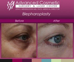 Before and After Eyelid Surgery