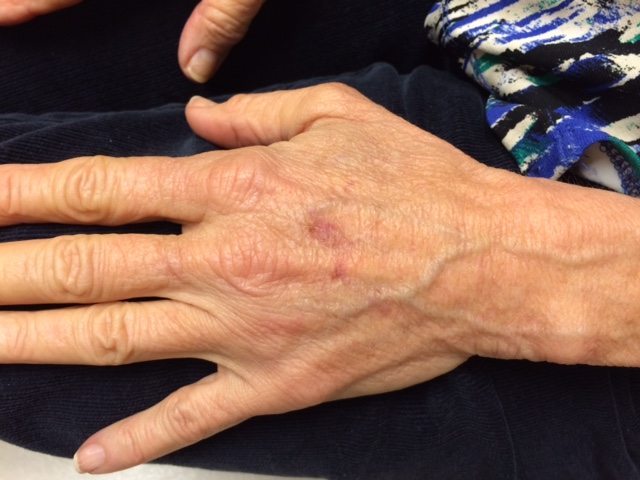 Hands Before Radiesse Injectable Filler