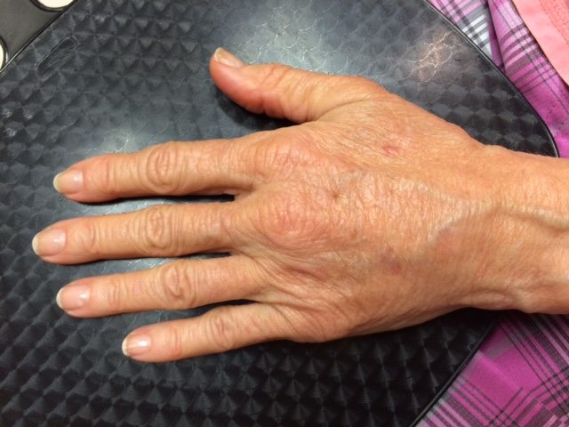 Hands After Radiesse Injectable Filler Treatment