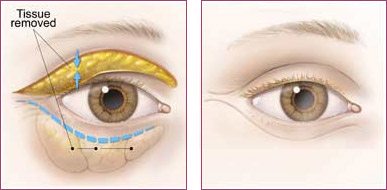 blepharoplasty illustration