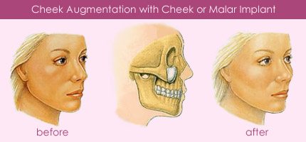 cheek implants