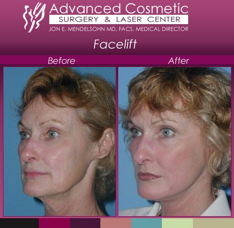 female facelift before and after 2