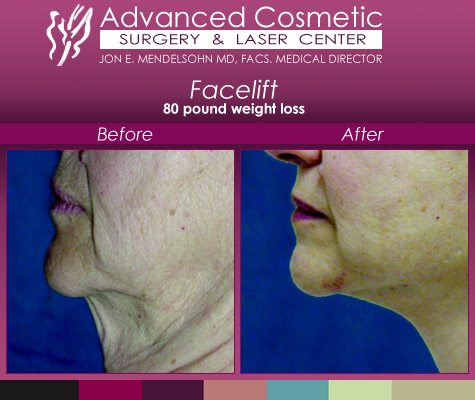 female facelift and neck