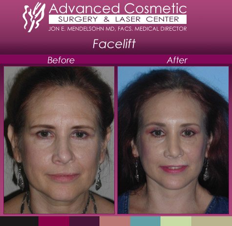 woman facelift before and after