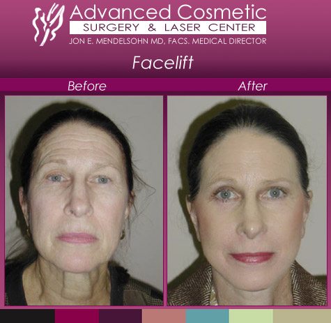 woman facelift before and after 2