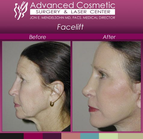 woman facelift and jaw