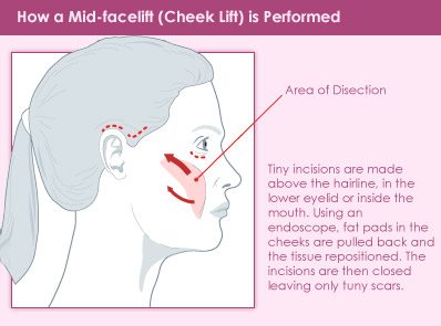 mid facelift cheeklift