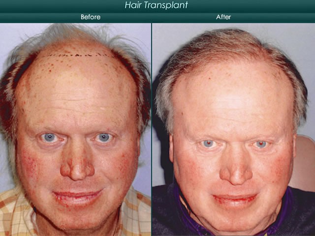 hair restoration before and after