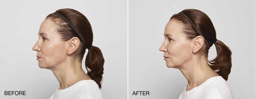 Carol before and after profile
