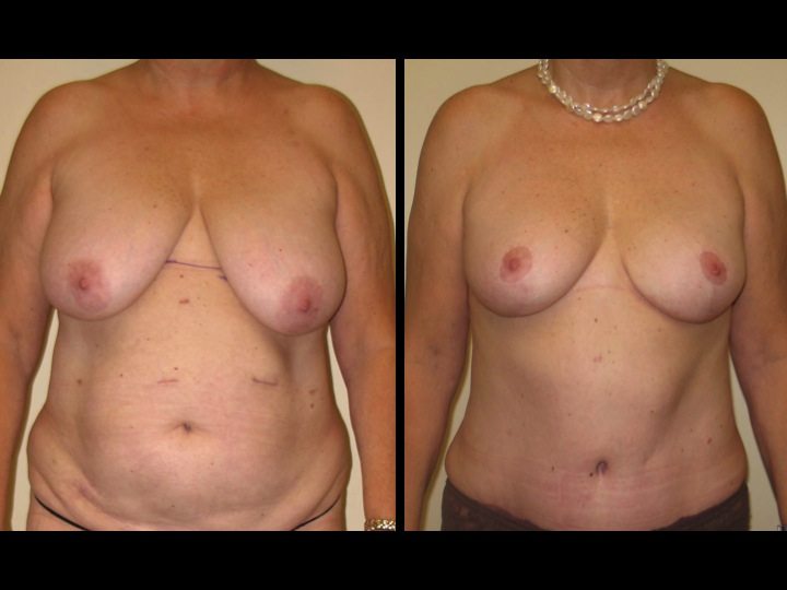 breast augmentation before and after front view