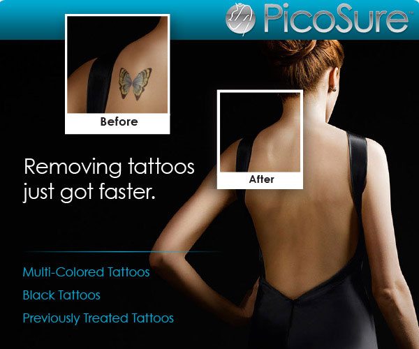 Picosure-Laser Tattoo Removal | Advanced Cosmetic Cincinnati