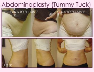 right abdominoplasty before and after