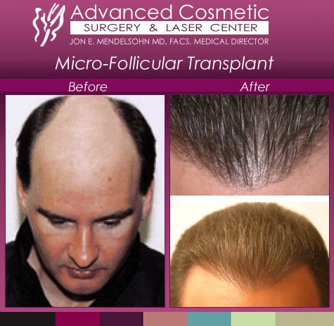 Hair Transplant Before and After Gallery  NeoGraft Hair Restoration Tampa