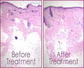 before treatment after treatment