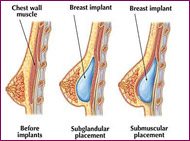 breast augmentation type diagram