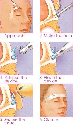 browlift procedure