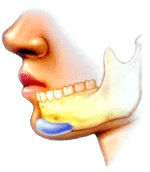 chin implant artistic rendering