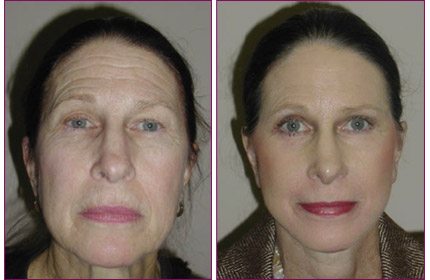 facelift before after