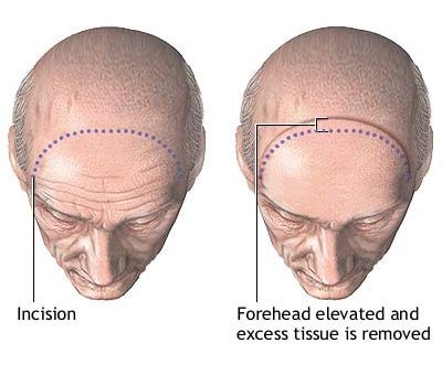 forehead_series_2