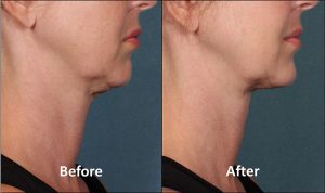 kybella before after