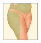 liposuction thigh areas