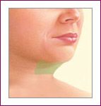 liposuction neck area