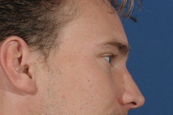 male rhinoplasty after