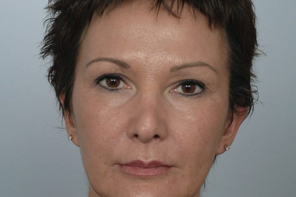 rhinoplasty-11