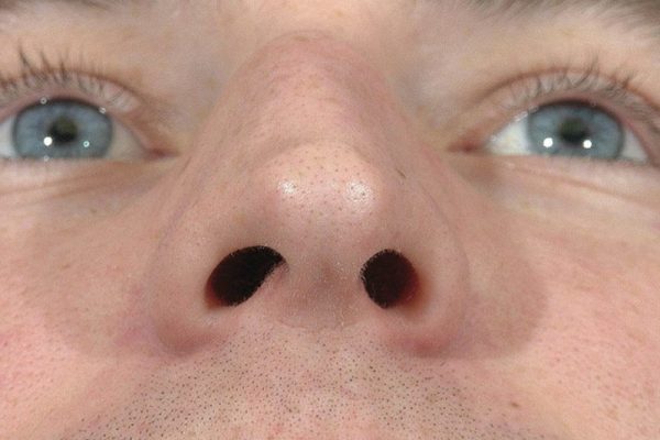 rhinoplasty-111
