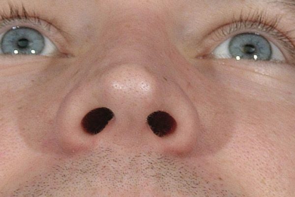 rhinoplasty-12