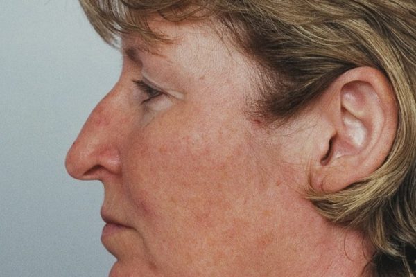 rhinoplasty-15