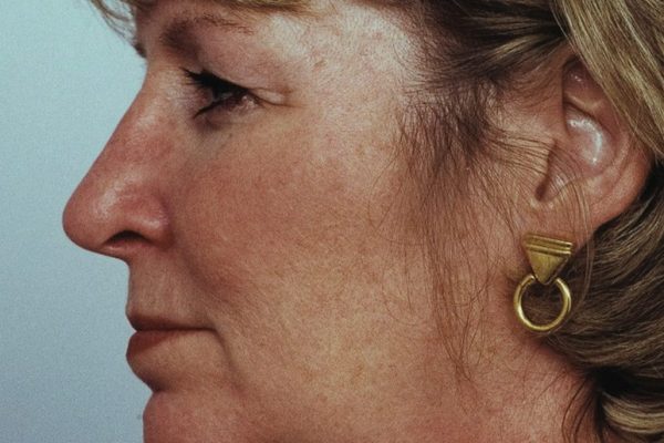 rhinoplasty-16