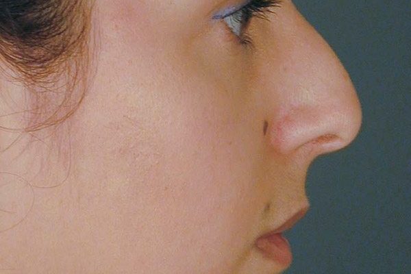 rhinoplasty-17