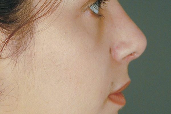 rhinoplasty-18