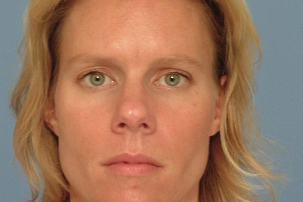 rhinoplasty-19