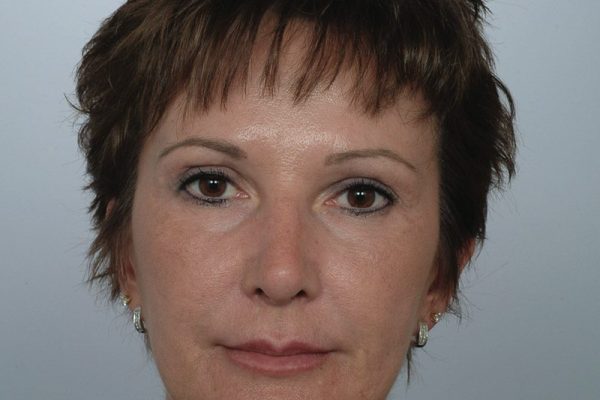 rhinoplasty-21