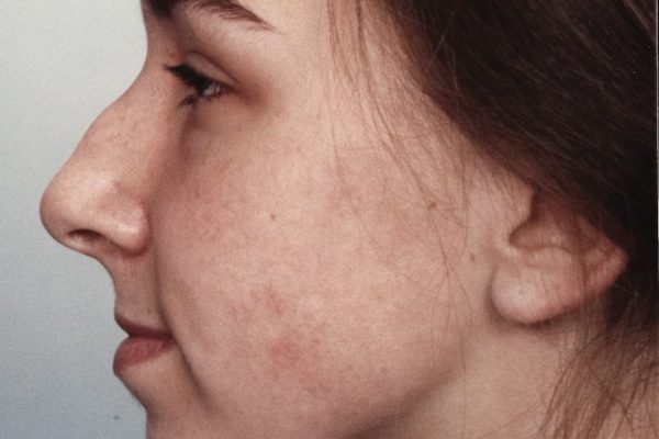 rhinoplasty-23