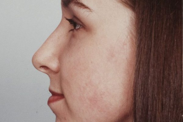 rhinoplasty-24