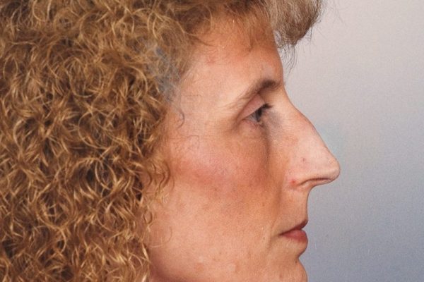 rhinoplasty-25