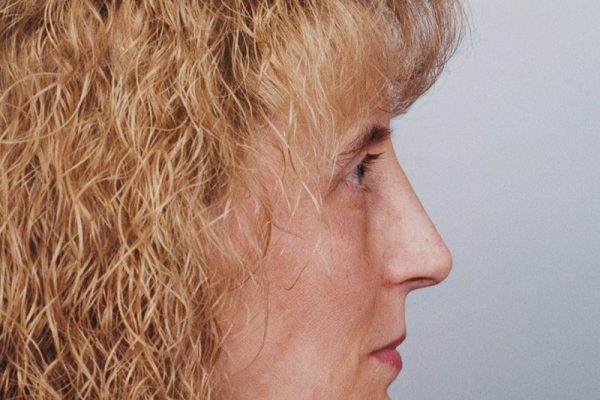 rhinoplasty-26