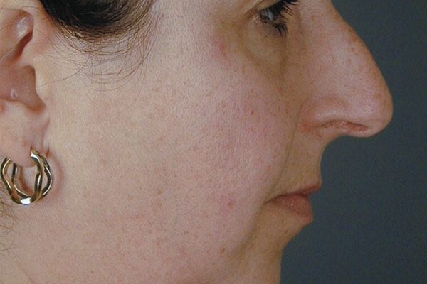 rhinoplasty-27