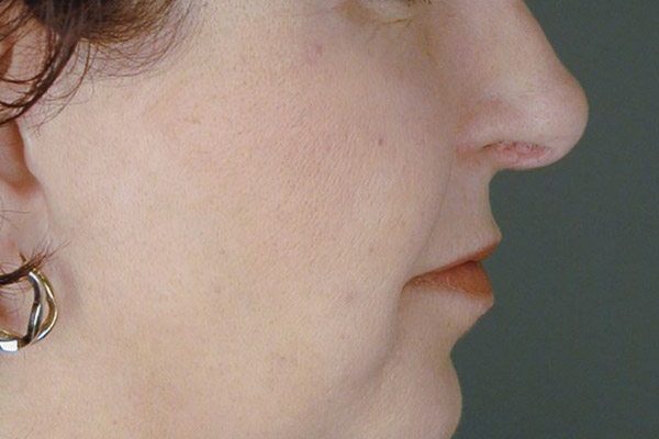 rhinoplasty-28