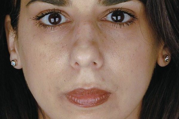 rhinoplasty-29