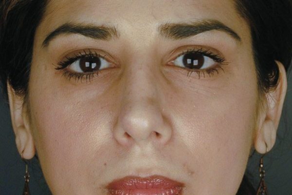 rhinoplasty-30