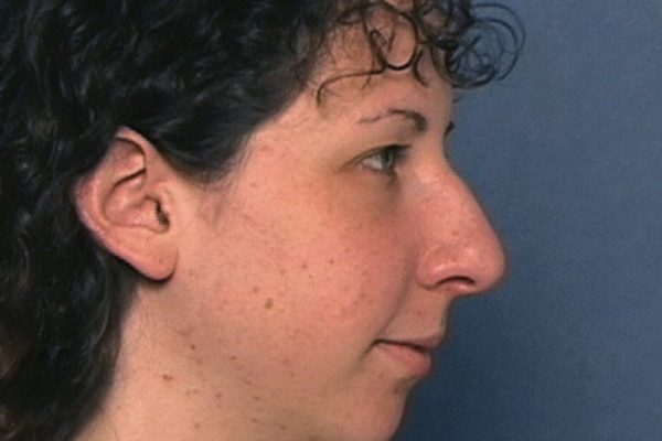 rhinoplasty-31