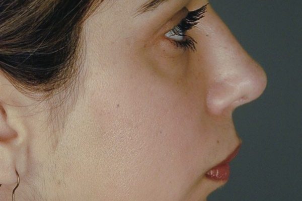 rhinoplasty-32