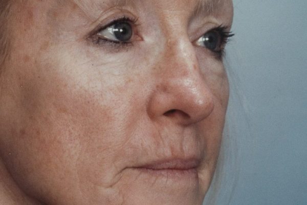 rhinoplasty-33