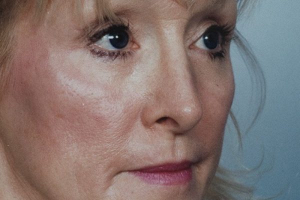 rhinoplasty-34