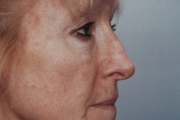rhinoplasty-35