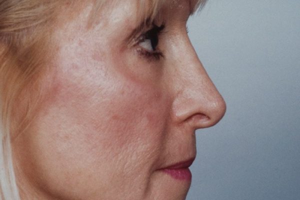 rhinoplasty-36